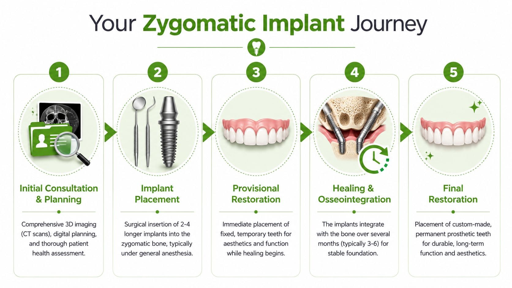 A five-step infographic detailing the surgical journey of receiving zygomatic dental implants, from consultation to final restoration.